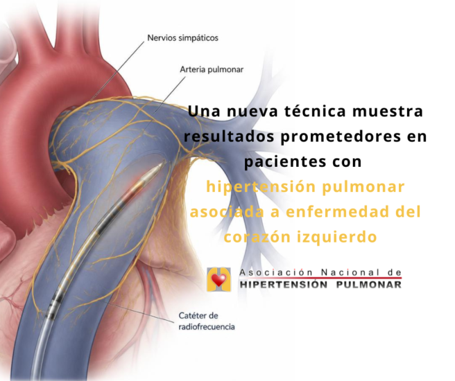 Una nueva técnica muestra resultados prometedores en pacientes con hipertensión pulmonar asociada a enfermedad del corazón izquierdo