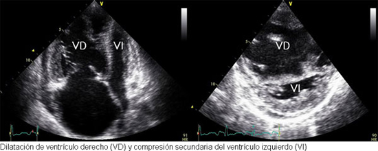 Dilatación de ventriculo derecho (VD) y compresión secundaria del ventriculo izquierdo (VI)